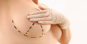 Aspectos técnicos das mastectomias profilática e terapêutica